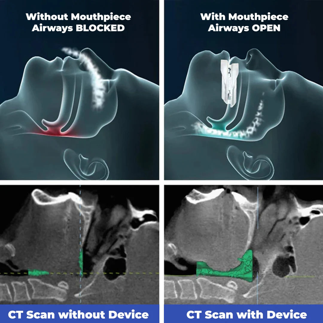 Anti-Snoring Mouthpiece